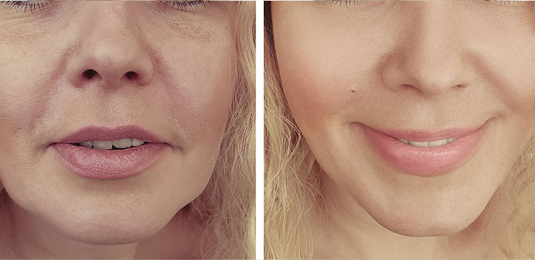 lifting facial