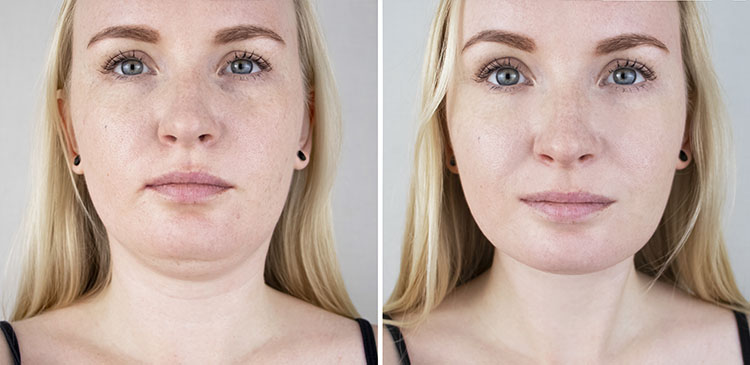 lifting facial
