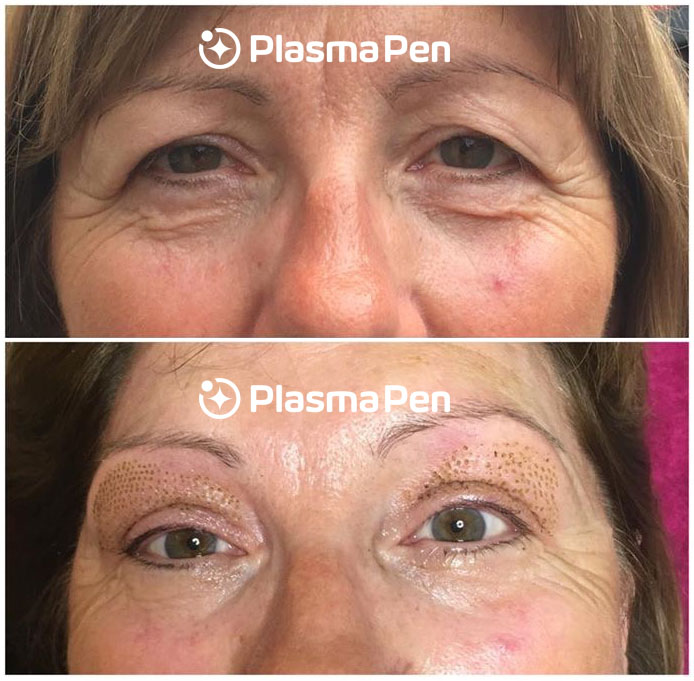 tratament plasma pen