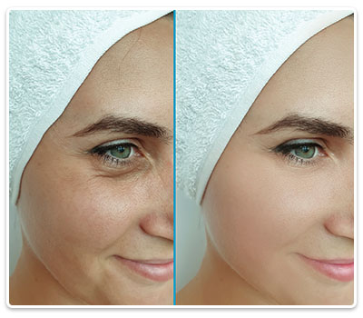 lifting facial