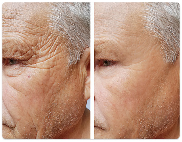 lifting facial