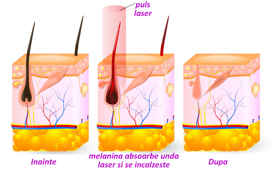 epilare cu laser